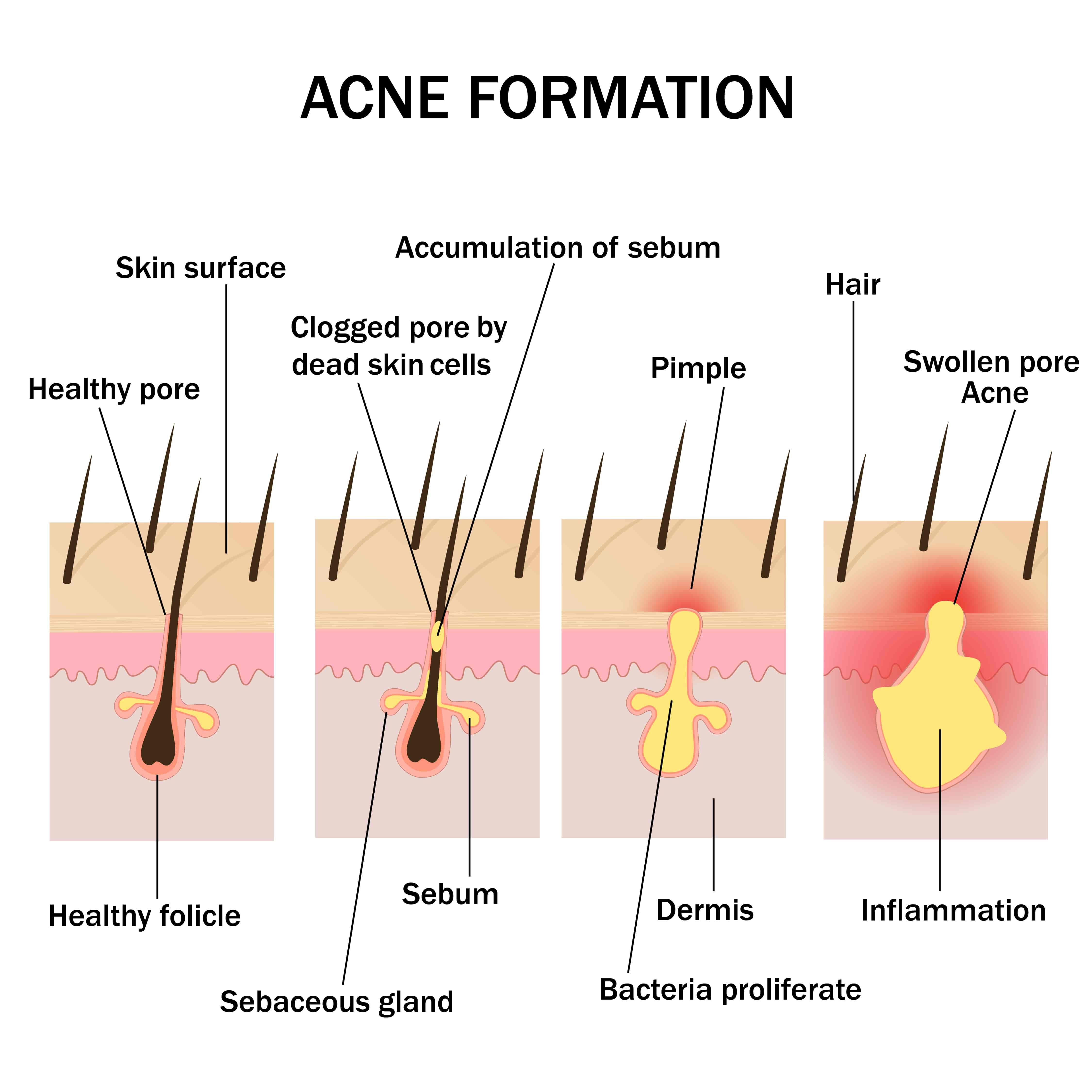 Got Acne? Learn How an Infrared Sauna Can Help Maintain Your Skin - JNH  Lifestyles Australia